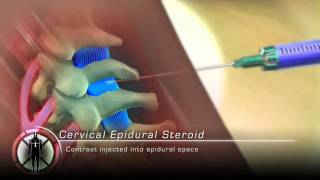 Cervical Epidural Steroid Injection Procedure Animation [upl. by Guzel77]