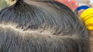 Remove thousand lice from black hair  Getting out all head lice from hair [upl. by Neerak]