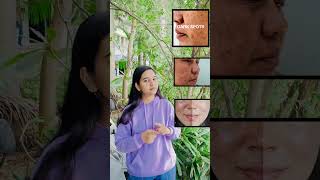 Kojic Acid Cream review Pigmentation  Acne prone  Skin Whitening kojicacid skincare kojicsoap [upl. by Sidell]