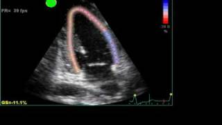 ABNORMAL STRAIN LONGITUDINAL ECHO [upl. by Diane]