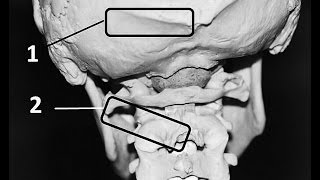 What is Occiptial Neuralgia [upl. by Norha482]