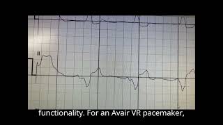 ECG after 6 months leadless pacemaker implantation Aveir VR [upl. by Selinda]