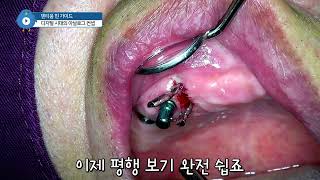 참 쉬운 flapless implant 🧷🧷 핀 가이드와 open healing iGBR로 손쉽게 극뽁 [upl. by Karlene]