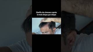 Résultat de la greffe de cheveux  Greffe de cheveux en Turquie  Transplantation capillaire [upl. by Rabaj]