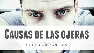 Causas de ojeras [upl. by Goddord]