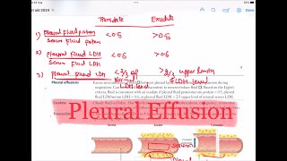 Pleural Effusion  Transudate Vs Exudate Respiratory 47  First Aid USMLE Step 1 in UrduHindi [upl. by Khan]