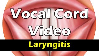 Vocal cords of a person with hoarse voice [upl. by Addia]