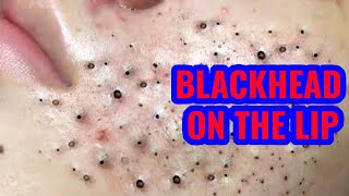 How To Treat a Blackhead On The Lip [upl. by Idaline293]