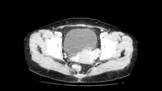 Right Paraduodenal Hernia [upl. by Hamfurd434]