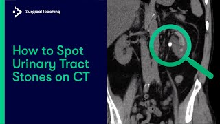 Urinary Tract Stones  How do we Diagnose them on CT Scans [upl. by Jeminah]