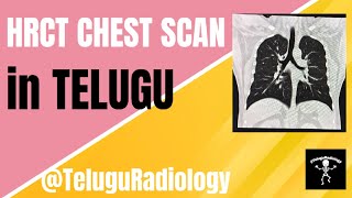 HRCT CHEST SCAN IN TELUGU TeluguRadiology [upl. by Seiden768]