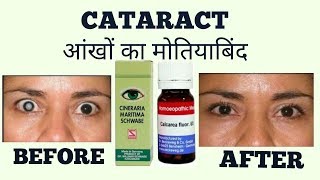 CATARACTआँखों का मोतियाबिंद HOMOEOPATHIC TREATMENT [upl. by Kcirre]