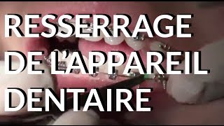 Resserrage de lappareil dentaire  Appareildentaireinfo [upl. by Nuzzi108]