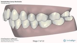 Invisalign Clincheck adulte Orthodontiste Lemay Sherbrooke NM48 143234 [upl. by Lleruj]