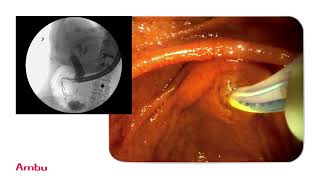 Dr Sam Serouya Performs amp Narrates a Sphincterotomy and Stent Placement Using the aScope™ Duodeno [upl. by Madel]