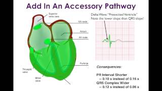 WolffParkinsonWhite WPW and Associated Arrhythmias [upl. by Dempster]