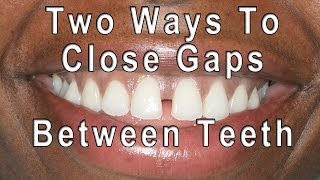 How to Close Gaps Between Teeth [upl. by Fabio366]