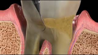 Laser Assisted Periodontal Therapy [upl. by Reidar]