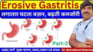 Understanding Erosive Gastritis Causes Symptoms and Management Strategiesdrramakantsharma7 [upl. by Ttelrahc]