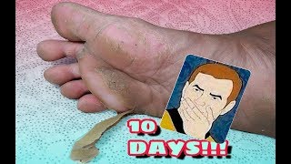 Skin Recovery  How fast do callus grow back Callus Trimming [upl. by Asert]