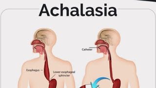 Achalasia Esophageal disorderSwallowing difficulty Cardiospasm mkmedicine medicalsolution [upl. by Der]