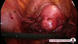 Laparoscopic Surgery For Severe Endometriosis by Dr Abayomi Agbetoba [upl. by Waldman]