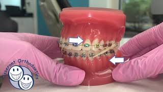 Elastics in Orthodontics  Overview [upl. by Anura691]