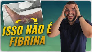 ISSO AQUI NÃO É FIBRINA ENTENDA Fibrina ou Esfacelo [upl. by Dedrick]