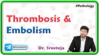 13 Thrombosis And Embolism  USMLE Step 1 Pathology [upl. by Eugine882]