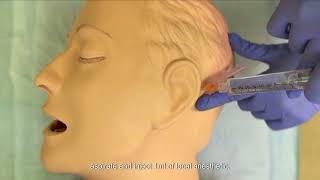 Scalp Block Technique for Awake Craniotomy [upl. by Hogg]