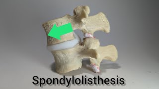 Spondylolisthesis Lumbar Model by Dynamic Disc Designs Grade 1 Anterolisthesis [upl. by Gillett]