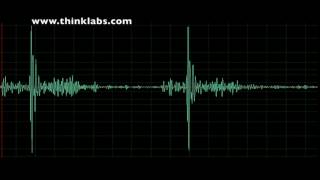 Takotsubo Cardiomyopathy [upl. by Joao623]