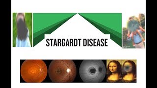 Stargardts Disease Hindi [upl. by Oinotnaesoj]