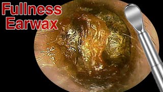 BIGGEST Ear Wax Difficult Removal  EP3  Doctor Anh [upl. by Fiedler258]