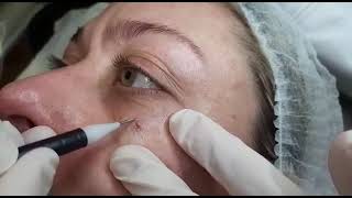 451 Seborrheic Keratosis Removal under the eye  skin type III [upl. by Leidba674]