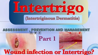 IntertrigoIntertriginous Dermatitis Assessment  Prevention and Management [upl. by Catrina]