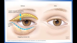 What to expect with an eyelid lift [upl. by Eislek]