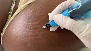 Stretch Marks Inkless Removal Boleyn Treatment Los Angeles 🌍 shorts [upl. by Garges248]