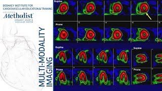 Nuclear Cardiology Understanding the Basics John J Mahmarian MD October 16 2018 [upl. by Ennalyrehc195]