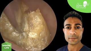 1278  x3 Ear Wax Removal Videos [upl. by Nickolas596]