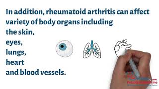 Rheumatoid Arthritis For Healthcare Professionals Summarized In 4 Minutes [upl. by Lekcar]