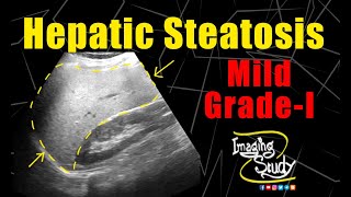 Mild Hepatic Steatosis  Mild Fatty Infiltration  Ultrasound  Case 170 [upl. by Elleina361]