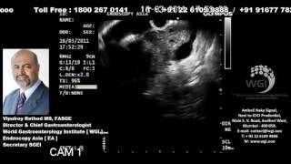 Endoscopic procedure of pancreas Mass [upl. by Kosel]