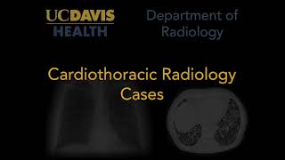 Complete left lower lobe atelectasis on chest radiograph [upl. by Edgar]