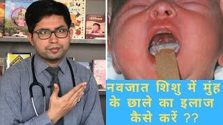 Oral candidiasis  Oral white patch  How to manage Oral thrush in baby  how to clean baby mouth [upl. by Nylirak]