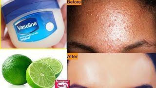 How To Remove Pimples Overnight  Acne Treatment Get rid of pimples overnight Vaseline and Lemon [upl. by Eimot657]