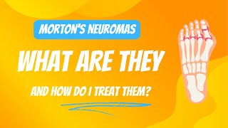 What is a Morton’s Neuroma  Chiropractor  Kennewick WA [upl. by Teloiv481]