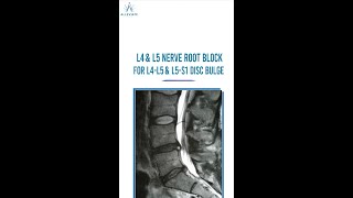 Nerve Root Block  Non Surgical Treatment for Back Pain [upl. by Aiek]