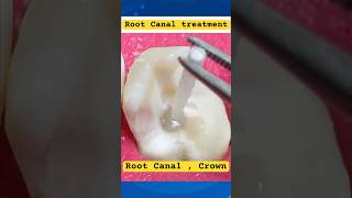 Root Canal  FiberOptic Post  Crown [upl. by Harbour]