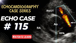 ECHO CASE 115  Echocardiography Spot Diagnosis Case Series [upl. by Pansie]